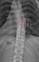 Scoliosis Vertebra Wedging