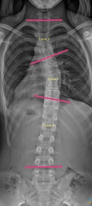 3 Curve X-Ray Example | Scoliosis