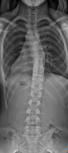 X-Ray of Thoracic Scoliosis | Schroth Method