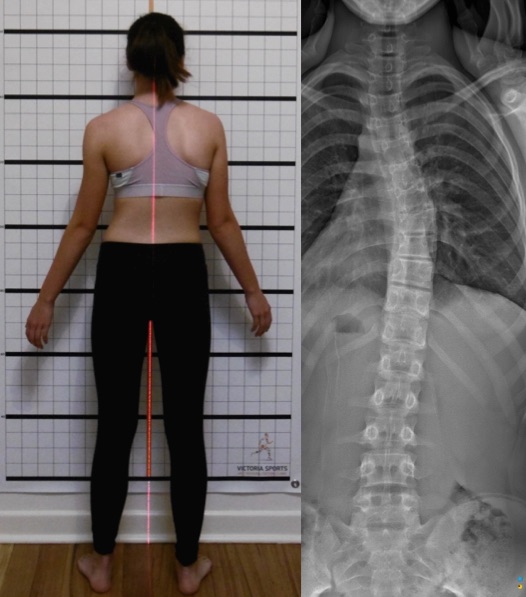 3 Curve Scoliosis | C Curve Scoliosis Example of Posture