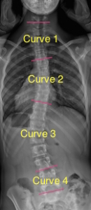 4 Curve X-Ray Example | Scoliosis