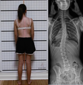 4 Curve Scoliosis | S Curve Scoliosis Example of Posture