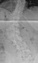 X-Ray of Adult Degenerative Scoliosis X-Ray