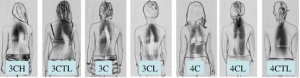 Scoliosis Curve Calssification