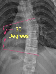 Cobb Angle Example | Scoliosis