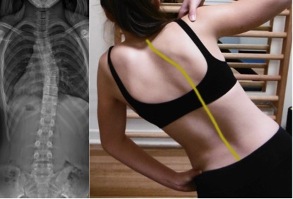 Schroth Example Thoracic Curve | Scoliosis Treatment | Melbourne
