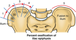 Risser Sign | Skeletal Maturity | Scoliosis