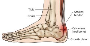 https://orthoinfo.aaos.org/en/diseases--conditions/severs-disease/